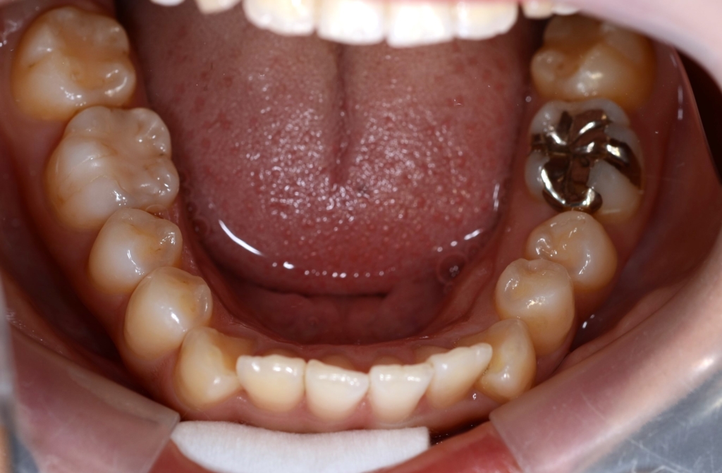 ガミースマイルで口元が出ているのを矯正治療する前の歯並び