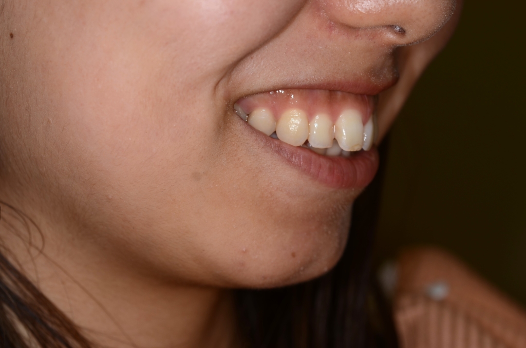 ガミースマイルで口元が出ているのを矯正治療する前の笑うと歯茎が見える口元と横顔