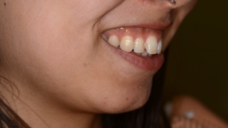ガミースマイルで口元が出ているのを矯正治療する前の笑うと歯茎が見える口元と横顔