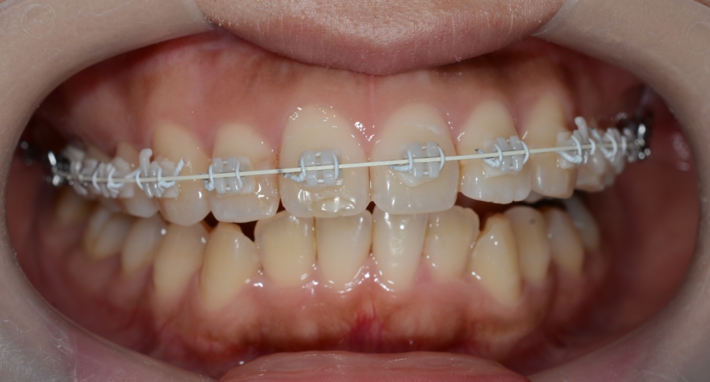 シザーズバイトの改善後の歯並び