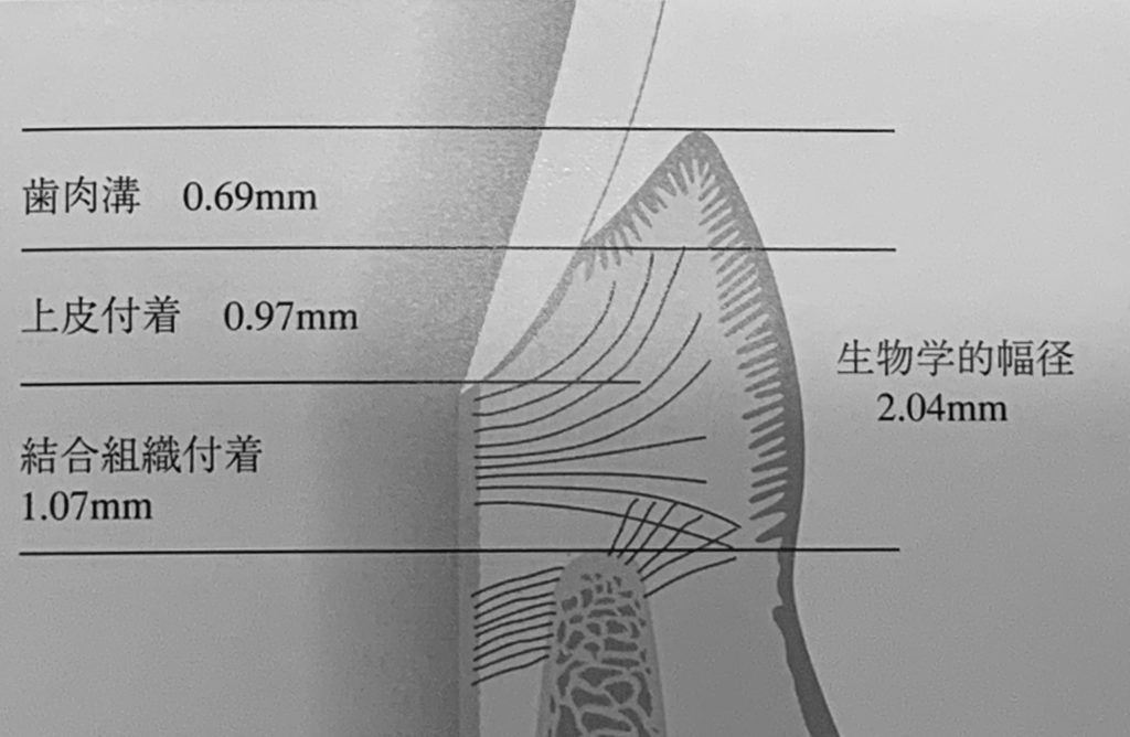 上皮付着0.97mmと結合組織付着1.07mmを合わせた2.04mmを生物学的幅径という。体の恒常性を保つ大事なことです。