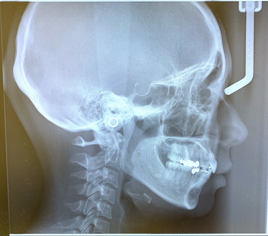 ガミースマイルで口ごぼの矯正治療後の頭蓋骨を横から見たレントゲン写真