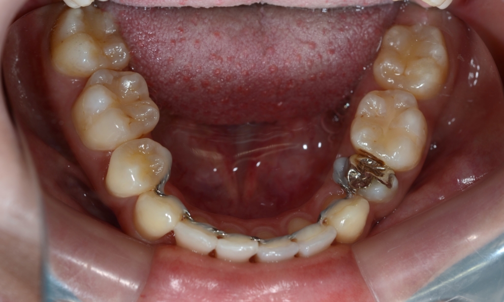 ガミースマイルで口元が出ているのを矯正治療した後の歯並び