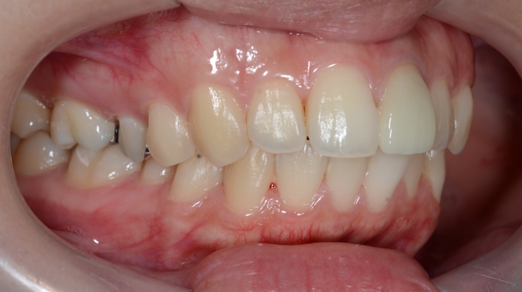 ガミースマイルで口元が出ているのを矯正治療する前の歯並び