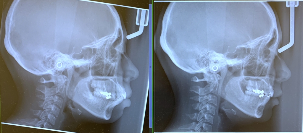 ガミースマイルで口ごぼの矯正治療前後の頭蓋骨を横から見たレントゲン写真の比較