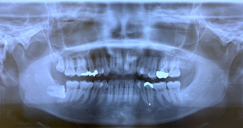ガミースマイルで口ごぼの矯正治療前の顎全体のレントゲン写真