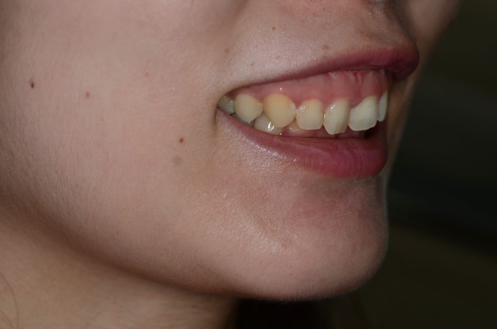 ガミースマイルを治すために美容外科にて口腔前庭縮小術をしたけれども、治っていなくて、相変わらず笑うと歯茎を大きく見えてしまう状態の笑顔。