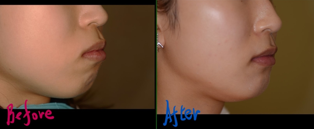 口ゴボの矯正治療前後の横顔の比較写真