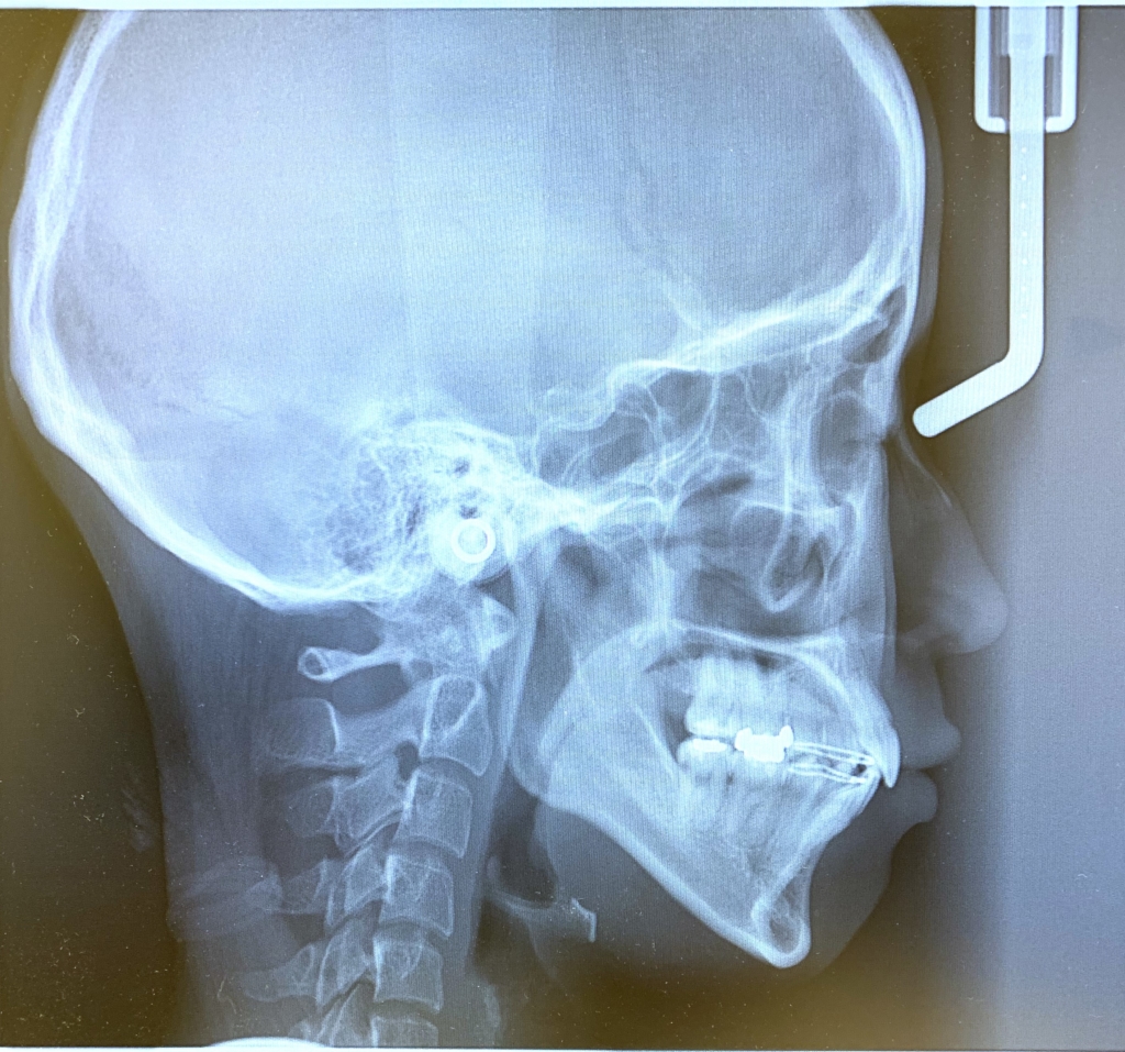ごぼ口を矯正治療した後の頭蓋突を横から写したレントゲン写真