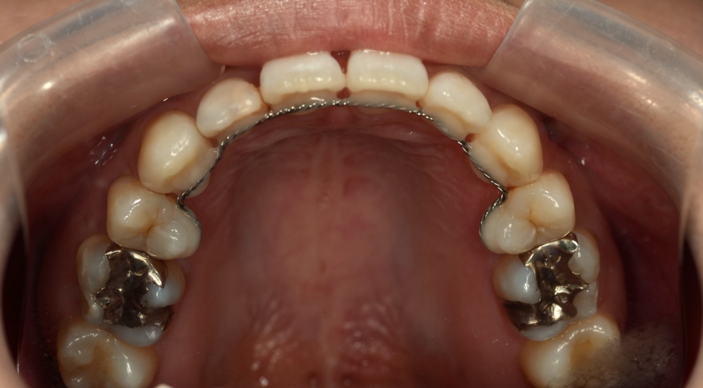 ごぼ口を矯正した後の歯並び
