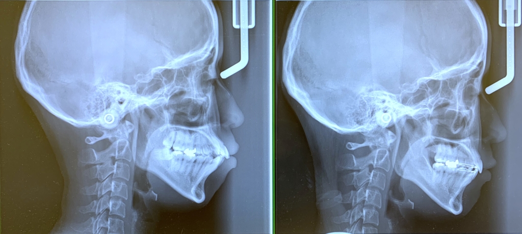 ごぼ口を矯正治療する前後のレントゲン写真の比較
