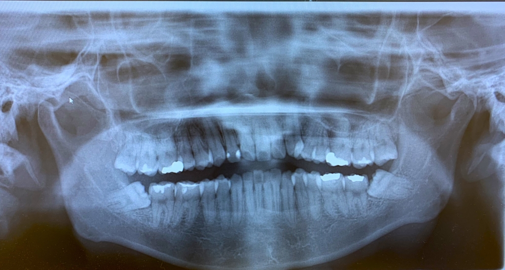 口ごぼを矯正治療する前の顎全体を写したレントゲン写真