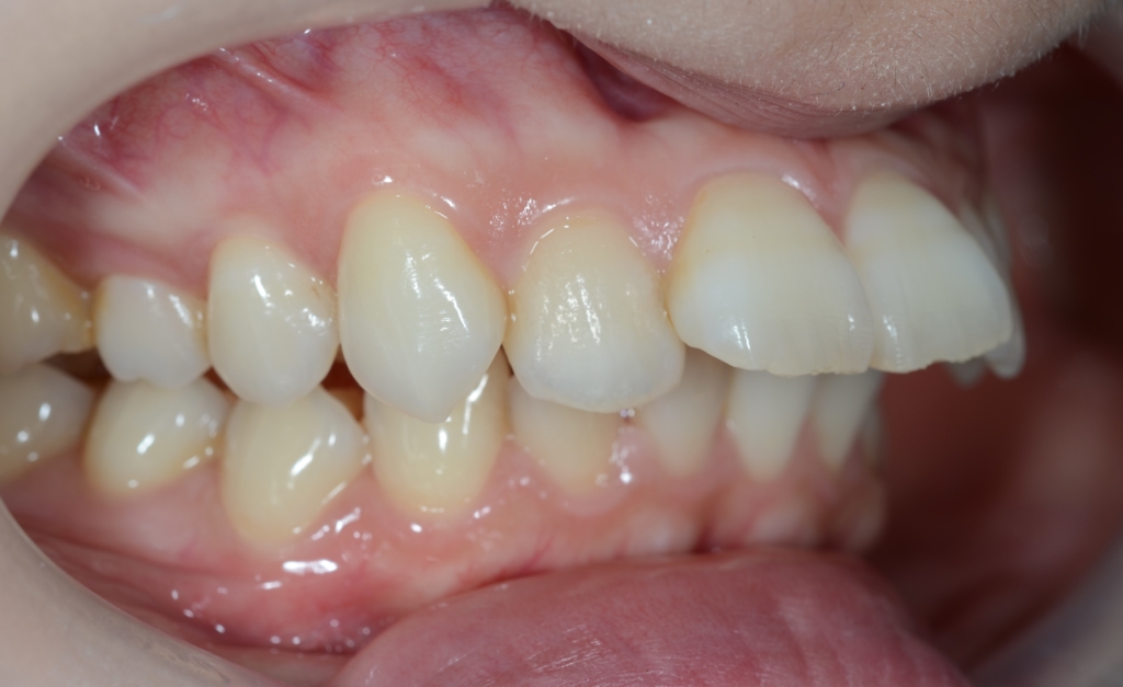 典型的な出っ歯の歯並び