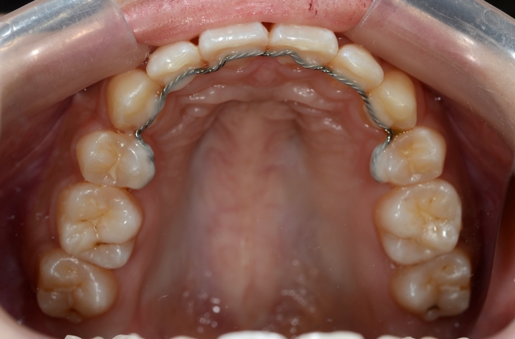 奥歯の噛み合わせは普通なのに出っ歯に見えてしまう方の矯正後の歯並び