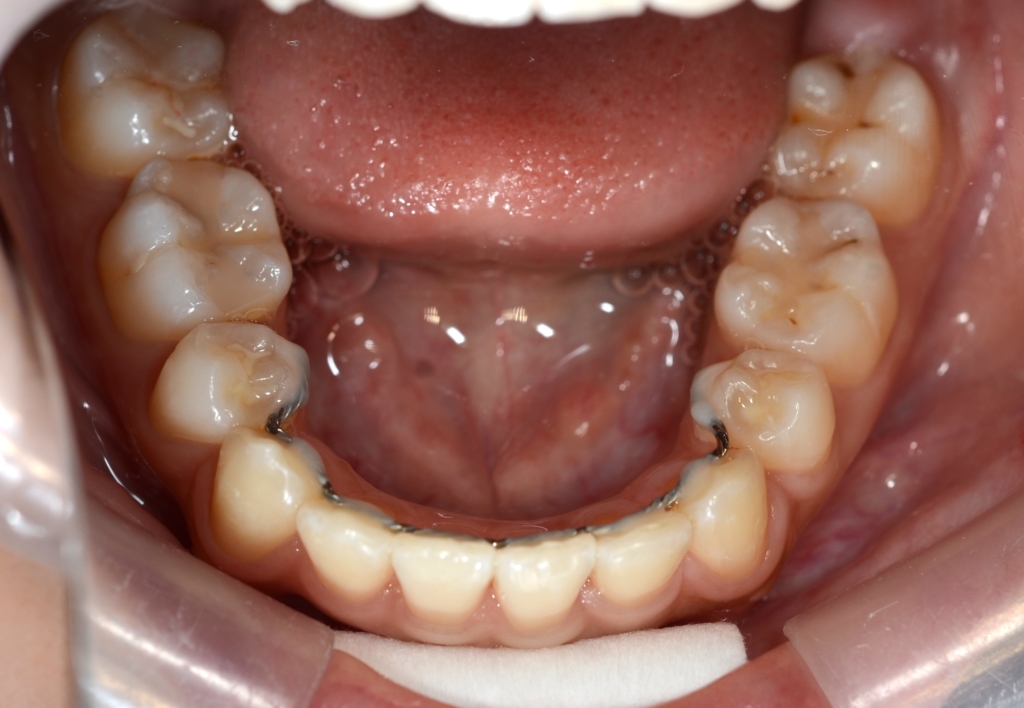 奥歯の噛み合わせは普通なのに出っ歯に見えてしまう方の矯正後の歯並び