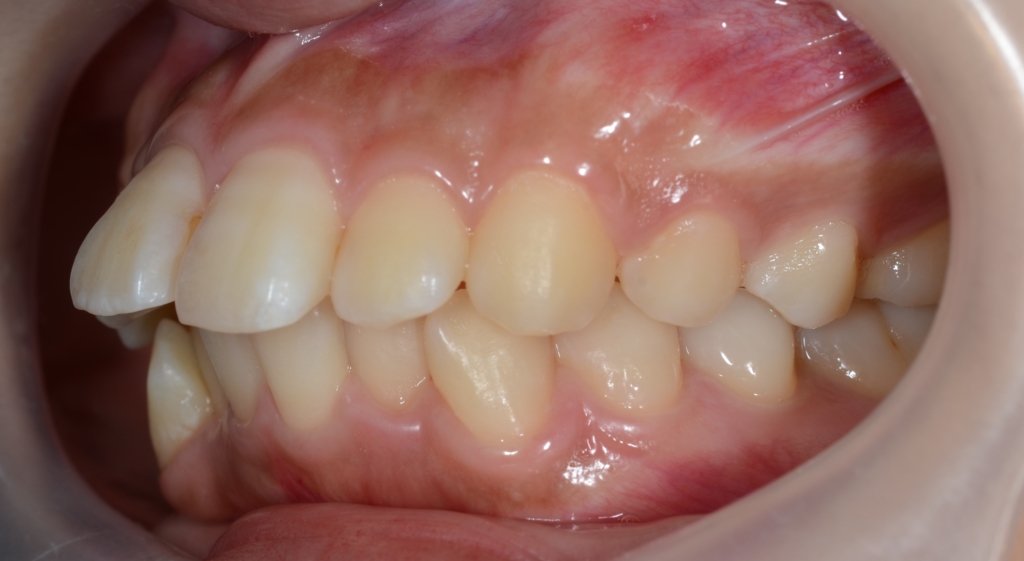 奥歯の噛み合わせは普通なのに出っ歯に見えてしまう方の矯正前の歯並び