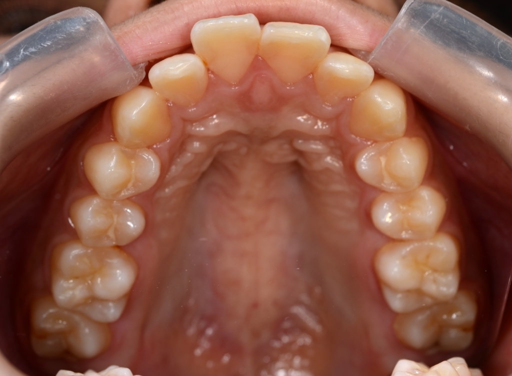 奥歯の噛み合わせは普通なのに出っ歯に見えてしまう方の矯正前の歯並び