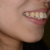 奥歯の噛み合わせは普通なのに出っ歯に見えてしまう歯並びの笑顔