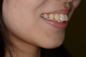 奥歯の噛み合わせは普通なのに出っ歯に見えてしまう歯並びの笑顔