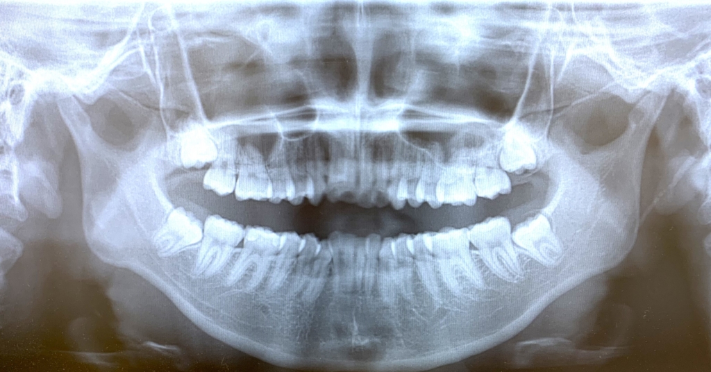 奥歯の噛み合わせは普通なのに出っ歯に見えてしまう歯並びの術前のレントゲン写真