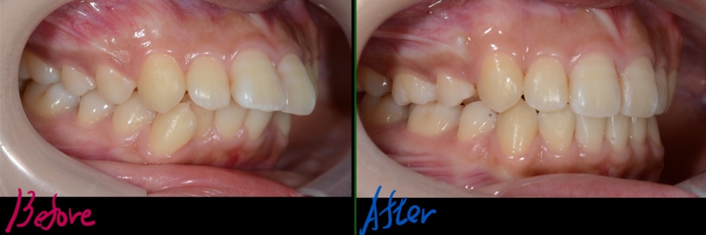 出っ歯で口ゴボの矯正治療前後の歯並びの比較写真