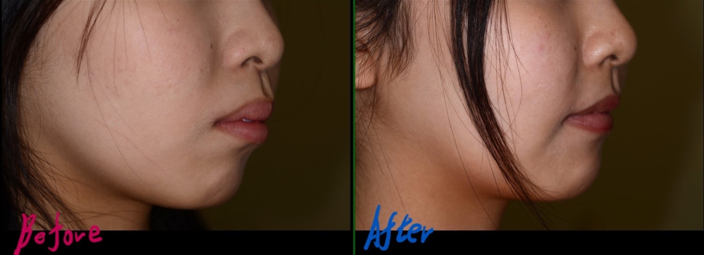 出っ歯で口ゴボの矯正治療前後の横顔の比較写真