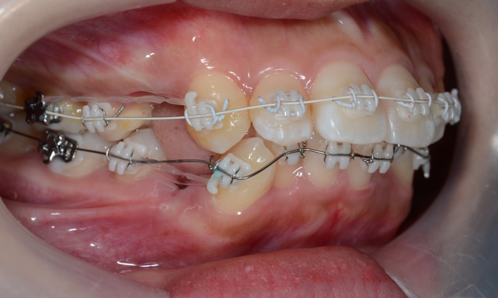 奥歯の噛み合わせは普通なのに出っ歯に見えてしまう歯並びに人の矯正治療開始