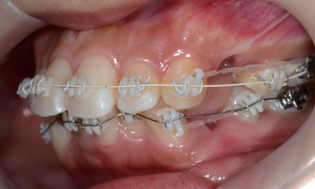 奥歯の噛み合わせは普通なのに出っ歯に見えてしまう歯並びの人の矯正治療開始