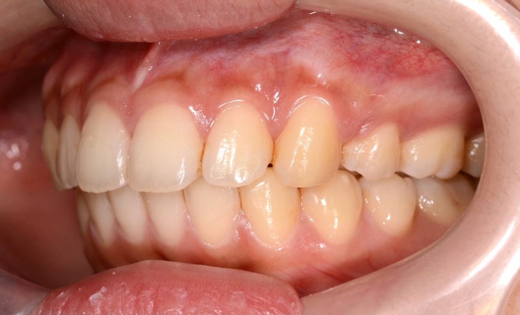典型的な出っ歯の矯正後の歯並