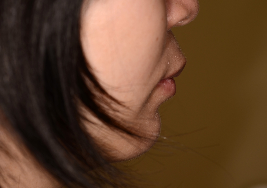 典型的な出っ歯の矯正後の横顔と口元