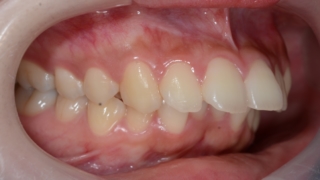 典型的な出っ歯の矯正前の歯並び