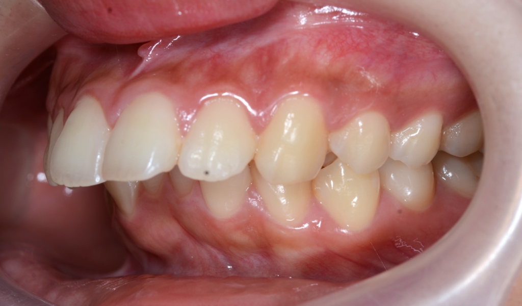 典型的な出っ歯の矯正前の歯並び