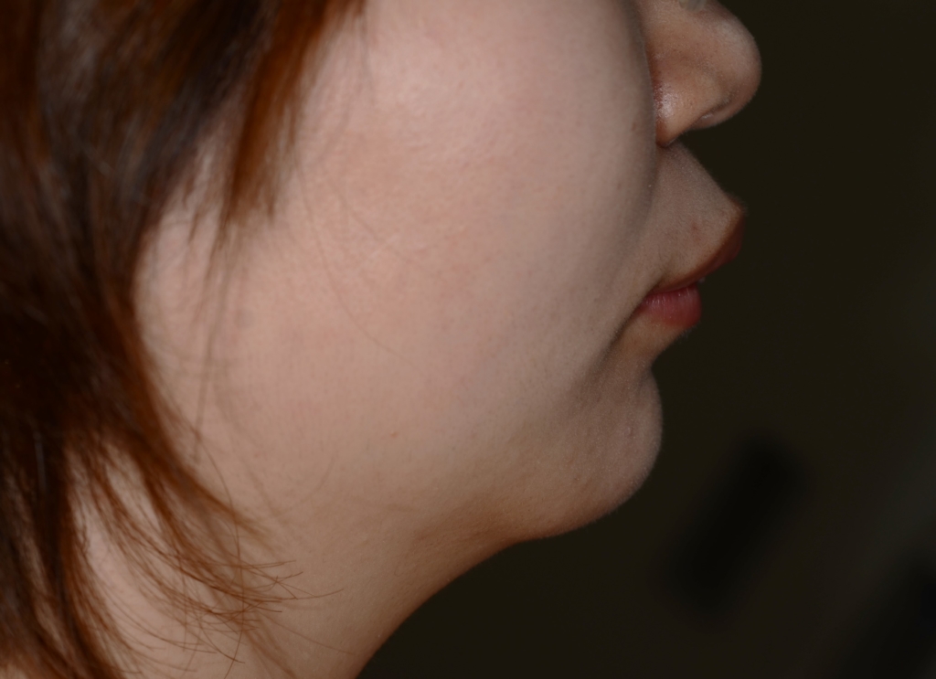 典型的な出っ歯の矯正前の横顔と口元