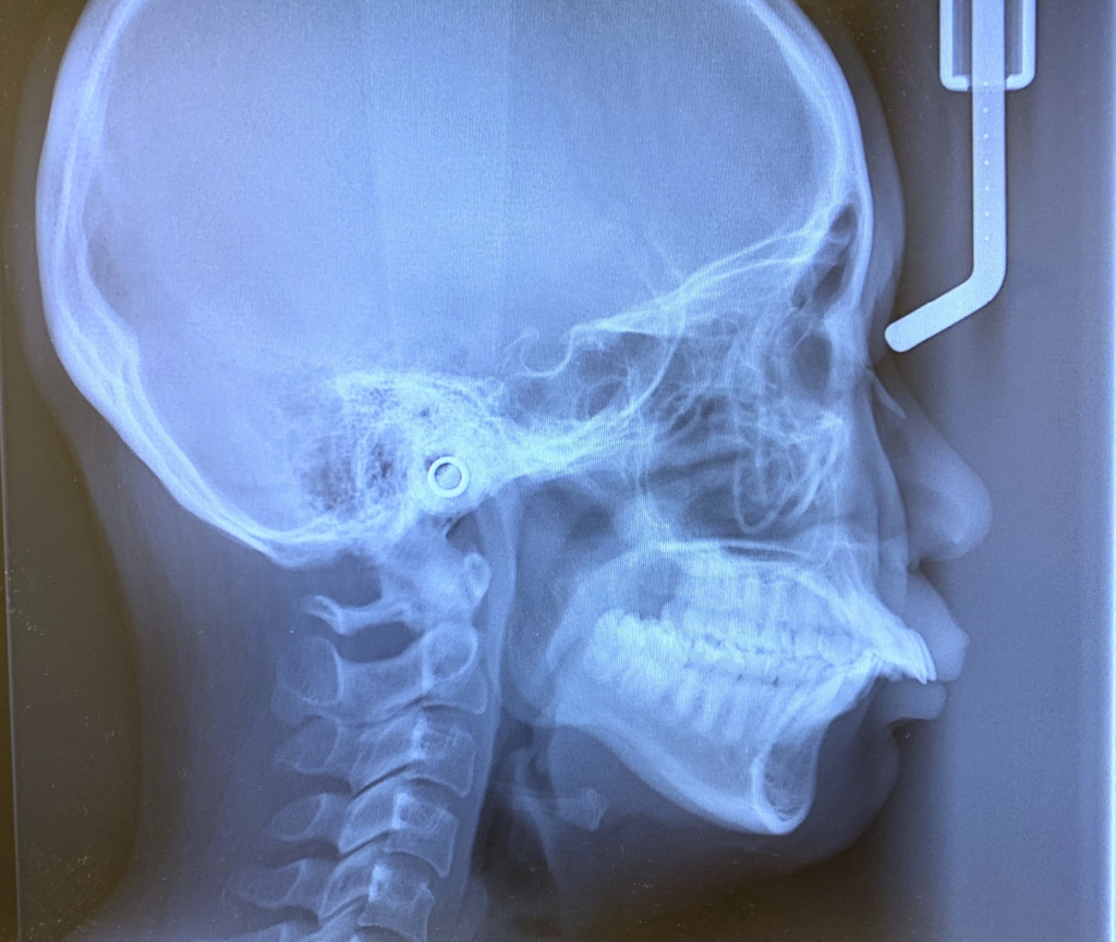 典型的な出っ歯の矯正前の頭蓋骨を横から見たレントゲン写真