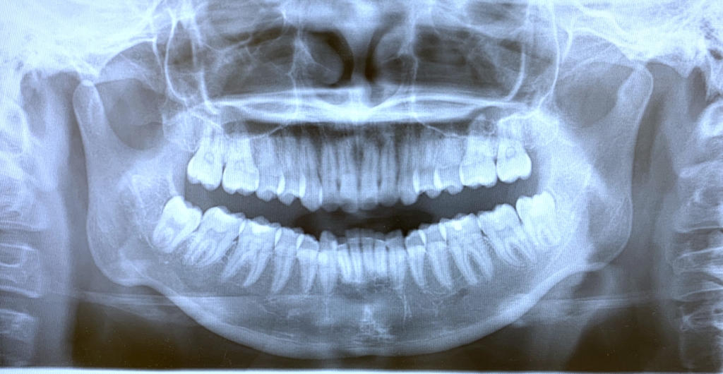 典型的な出っ歯の矯正前の顎全体のレントゲン写真