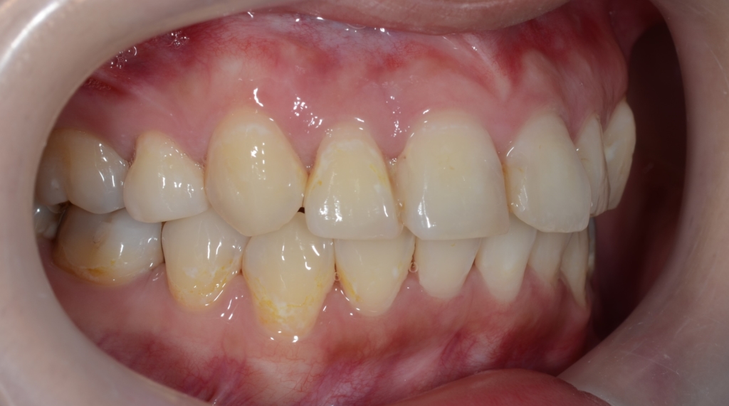 ガタガタのある出っ歯の歯並びの矯正後