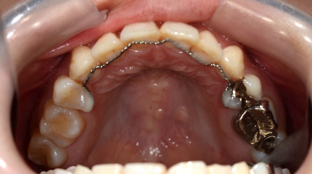 ガタガタのある出っ歯の歯並びの矯正後