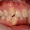 ガタガタのある出っ歯の歯並びの矯正前