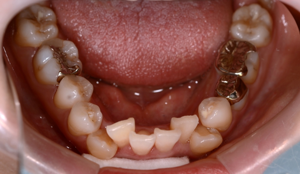 ガタガタのある出っ歯の歯並びの矯正前