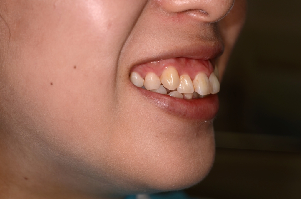 ガタガタのある出っ歯の歯並びの矯正前の口元で、笑うとガミースマイルもあります