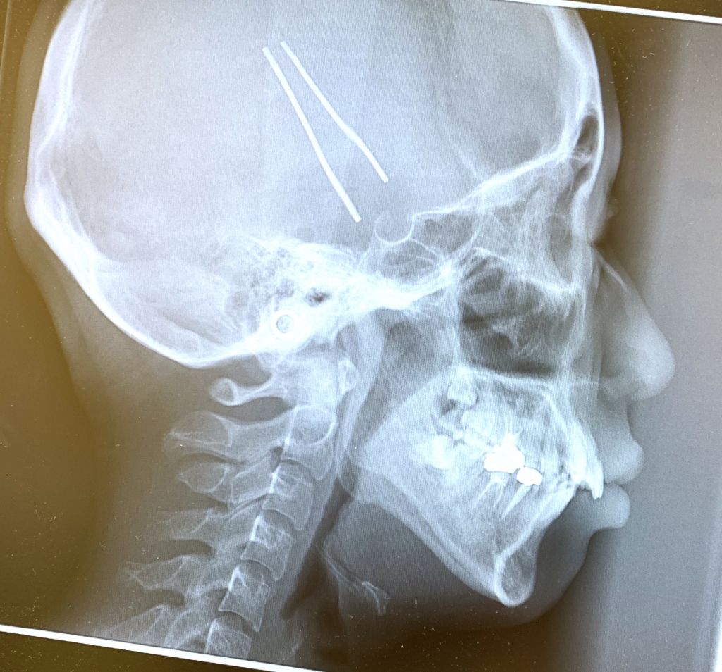 ガタガタのある出っ歯の歯並びの矯正前の頭蓋骨を横から見たレントゲン写真