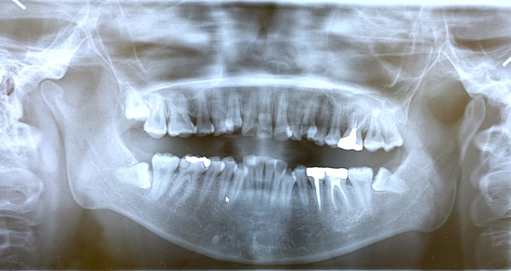 ガタガタのある出っ歯の歯並びの矯正前の顎全体のレントゲン写真