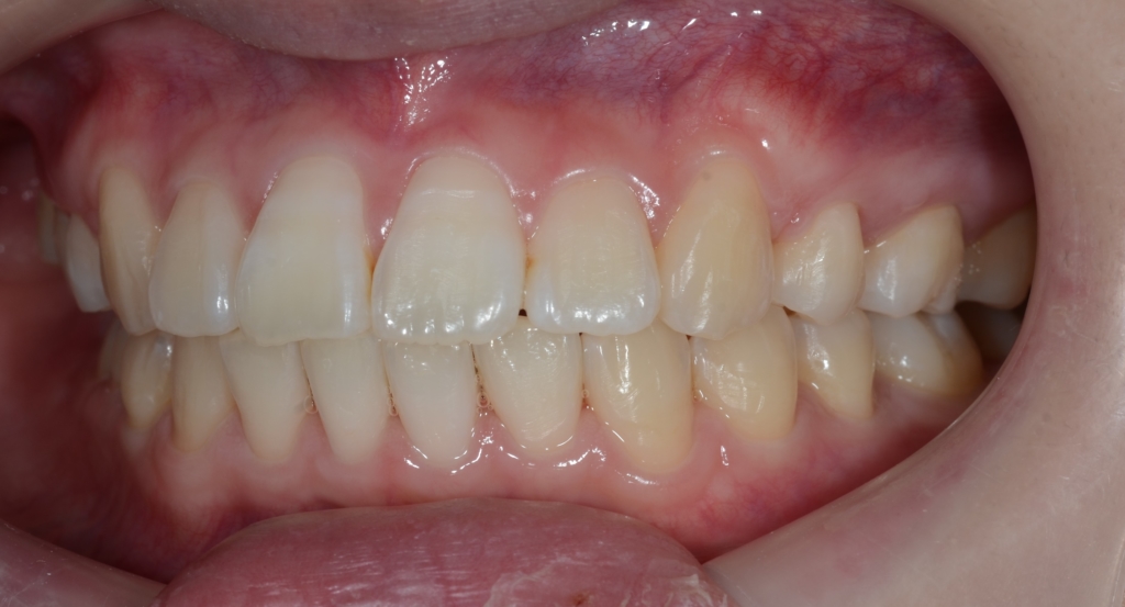 典型的な出っ歯の矯正後の歯並び