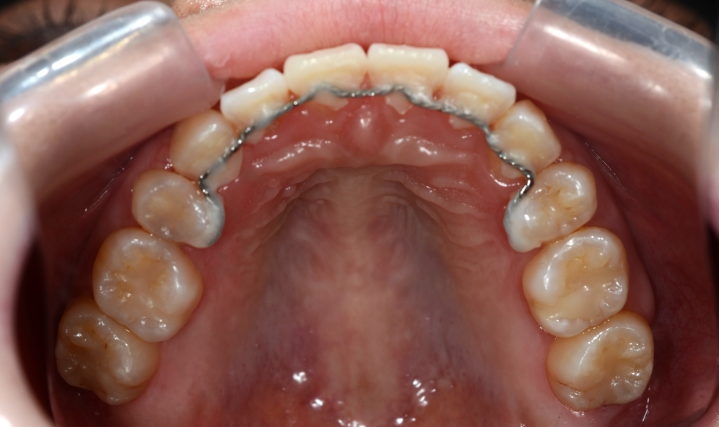 典型的な出っ歯の矯正後の歯並び