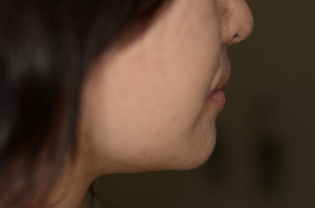 典型的な出っ歯の矯正後の口元と横顔