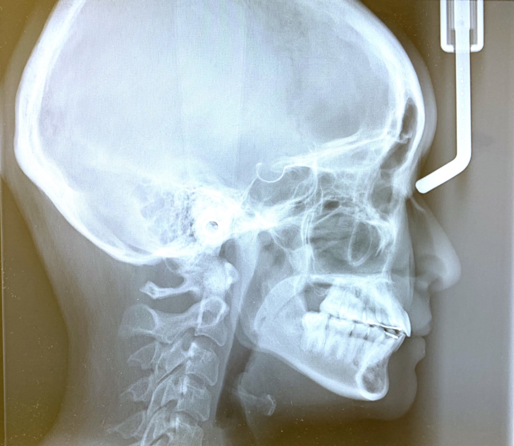 典型的な出っ歯の矯正後の頭蓋骨を横から見たレントゲン写真