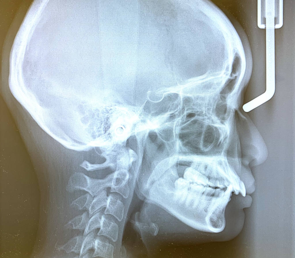 典型的な出っ歯の矯正前の頭蓋骨を横から見たレントゲン写真