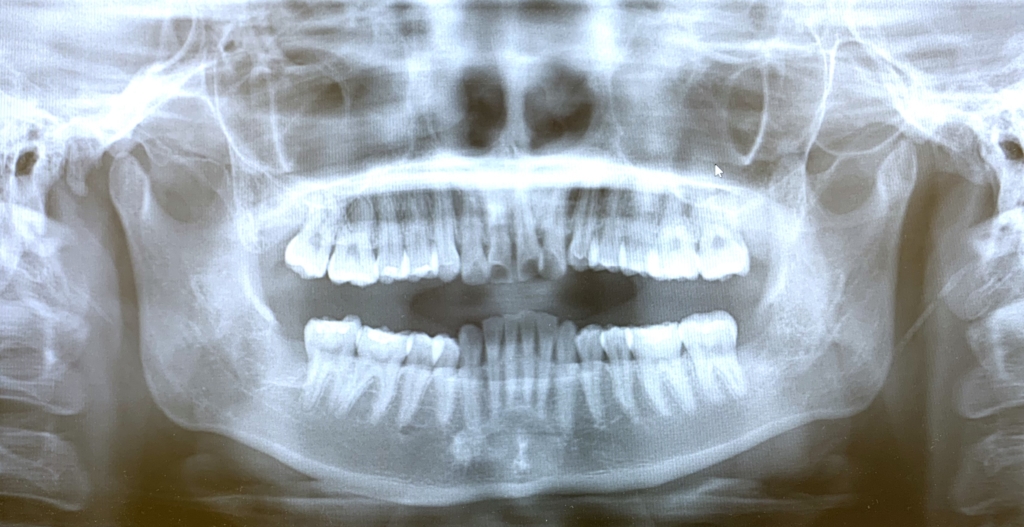 典型的な出っ歯の矯正前の顎全体のレントゲン写真
