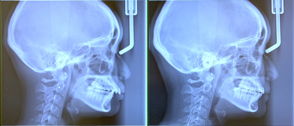 矯正治療前後のレントゲン写真の比較