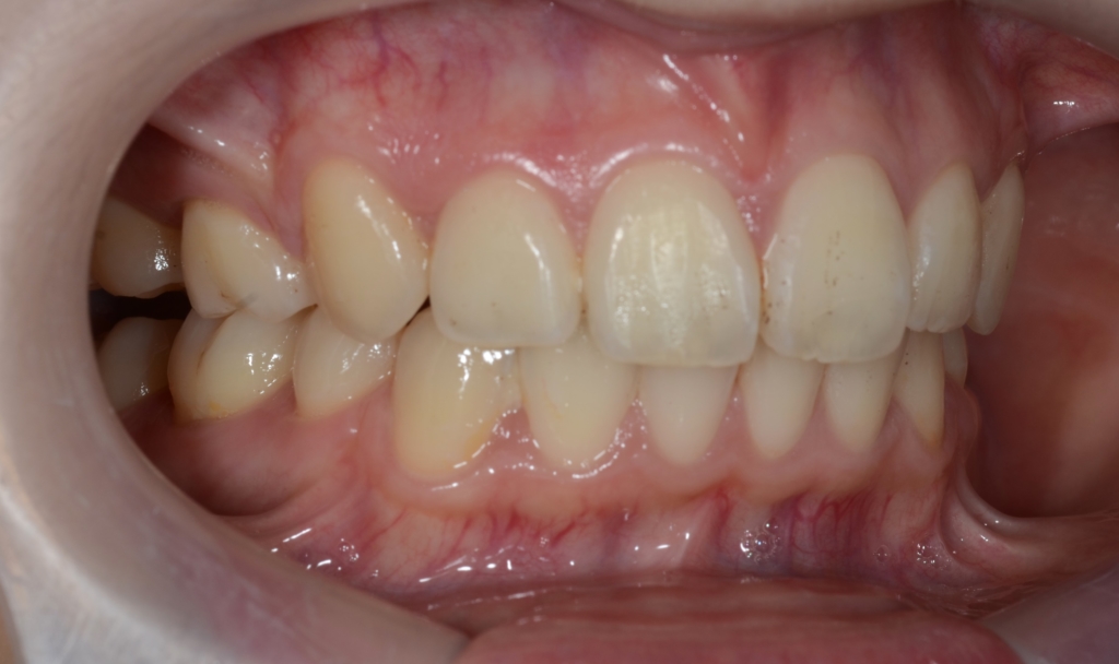 重度の八重歯を伴う乱ぐい歯と口ゴボを治した矯正後の歯並び